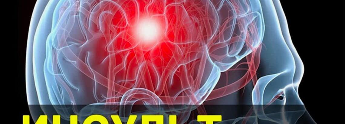 Инсульт. Признаки, симптомы, диагностика