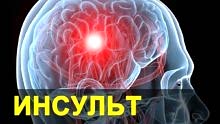 Инсульт. Признаки, симптомы, диагностика