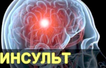 Инсульт. Признаки, симптомы, диагностика
